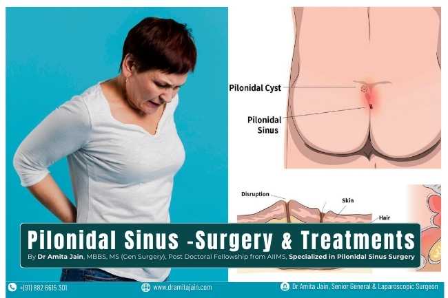 Pilonidal Sinus treatment